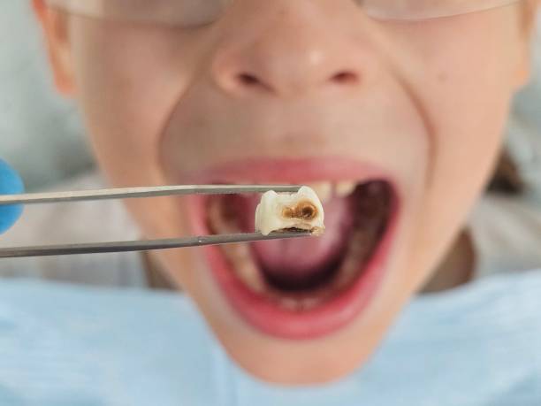 Best Urgent Care for Lost Fillings or Crowns in Caledonia, MN